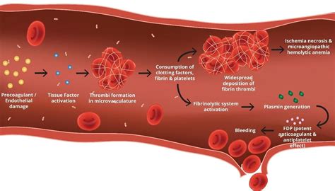 small dic|Disseminated intravascular coagulation .